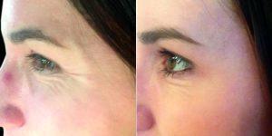 21 Year Old Woman Treated With Botox Before & After By Doctor Anita Saluja, MD, Melbourne Dermatologist