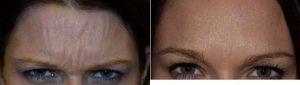 21 Year Old Woman Treated With Botox Before & After By Dr. Philip K. Robb Jr., MD, Atlanta Otolaryngologist