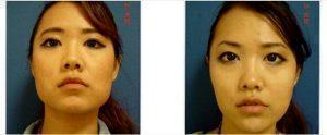 21 Year Old Woman Treated With Botox Before & After By Dr. Vincent D. Lepore, MD, San Jose Plastic Surgeon