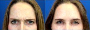 21 Year Old Woman Treated With Botox Before & After With Dr. Eric J. Yavrouian, MD, Glendale Facial Plastic Surgeon