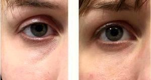 22 Year Old Woman Treated With Restylane To Tear Troughs With Dr. Mathew A. Plant, MD, FRCSC, Toronto Plastic Surgeon