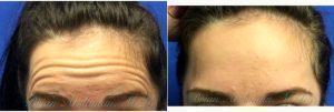 23 Year Old Desiring Preventative Treatment Of Forehead Wrinkles Before & After By Doctor Brian Arslanian, MD, Atlanta Plastic Surgeon