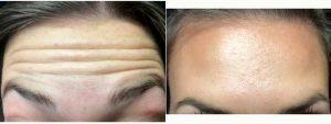 24 Year Old Woman Treated With Botox With Dr. Ramandeep Sidhu, MD, Issaquah Vascular Surgeon