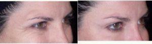 25 Year Old Woman Treated With Botox In The Crow's Feet By Dr Alex Eshaghian, MD, PhD, Encino Physician