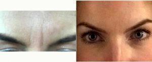 26 Year Old Woman Treated With Preventative Botox 11 Lines With Doctor Philip K. Robb Jr., MD, Atlanta Otolaryngologist