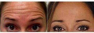 29 Year Old Woman Treated With Botox Before & After By Dr Dominic Brandy, MD, Pittsburgh Physician