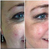 3 Units Botox Crows Feet Before And After