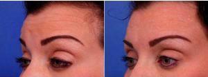31 Year Old Woman Treated With Botox - Treatment Areas Include Glabella, Forehead, Crows Feet Results With Dr Thomas J. Walker, MD, Atlanta Facial Plastic Surgeon