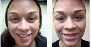 33 Year Old Woman Treated With Botox Under Eyes With Dr Cylburn E. Soden Jr., MD, Laurel Dermatologic Surgeon