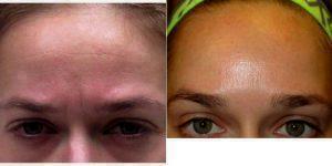 34 Year Old Woman Treated With Botox By Dr. Karen Beasley, MD, Baltimore Dermatologic Surgeon