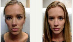 34 Year Old Woman Treated With Preventative Botox For Forehead