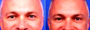 36 Year Old Man Treated With Botox - Areas Included Are Glabella, Crows Feet, And Jelly Roll With Dr. Thomas J. Walker, MD, Atlanta Facial Plastic Surgeon