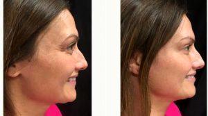 36 Year Old Woman Treated With Botox Around Eyes By Doctor Michele S. Green, MD, New York Dermatologist