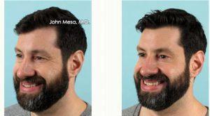38 Year Old Man Treated With Botox For Crow's Feet Wrinkles Before After By Dr. John Mesa, MD, New York Plastic Surgeon