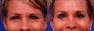 39 Year Old Woman Treated With Botox, Treatment Areas Include Glabella, Crows Feet, Jelly Roll With Doctor Thomas J. Walker, MD, Atlanta Facial Plastic Surgeon