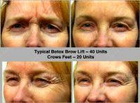 40 Units Of Botox For Brow Lift