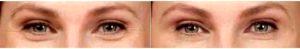 40 Year Old Woman Treated With Botox Under Eyes With Dr Robert W. Sheffield, MD, Santa Barbara Plastic Surgeon
