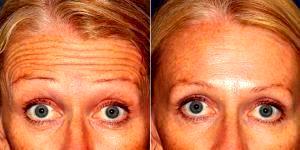 40 Year Old Woman Treated With Preventative Botox Forehead Lines By Doctor Sabrina Fabi, MD, San Diego Dermatologic Surgeon