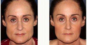41 Year Old Woman Treated With Botox By Dr Sabrina Fabi, MD, San Diego Dermatologic Surgeon