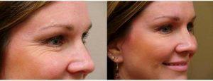 43 Year Old Woman Treated With Botox Around Eyes By Doctor Jonathan Amspacher, MD, Kansas City Plastic Surgeon