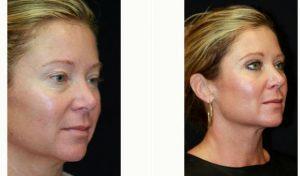 43 Year Old Woman Treated With Botox By Dr. Kris M. Reddy, MD, FACS, West Palm Beach Plastic Surgeon