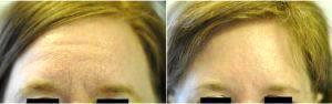 46 Year Old Woman Treated With Preventative Botox Forehead By Doctor Renuka Diwan, MD, Cleveland Dermatologic Surgeon