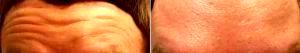 47 Year Old Man Treated With Botox Results By Doctor Ramandeep Sidhu, MD, Issaquah Vascular Surgeon