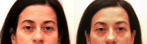 48 Year Old Woman Treated For Forehead Lines By Doctor Trevor M. Born, MD, Toronto Plastic Surgeon