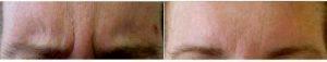 48 Year Old Woman Treated With Botox With Doctor Deborah E. Mendelson, MD, Phoenix Dermatologist