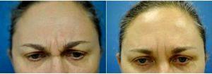 49 Year Old Woman Treated With Botox With Dr Richard G. Schwartz, MD, West Palm Beach Plastic Surgeon
