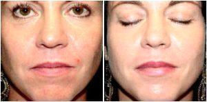 4week Views, Restylane™ For Lip Augmentation And Treatment Of Nasolabial Folds By Dr. Angelchik, Phoenix, Arizona Area