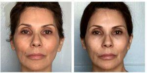 5 Syringes Of Juvederm Ultra Plus Combined To Temples By Anusha H. Dahanayake, NP, Doctor In Los Angeles, California