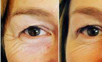 5 Units Botox Crows Feet Before And After