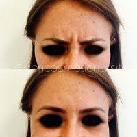 50 Units Botox Is Too Much As A First Glabella Treatment