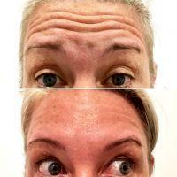 50 Units Of Botox Is Reasonable For Crows Feet And Forehead