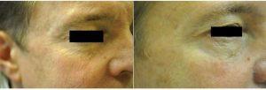 50 Year Old Man Treated With Botox With Dr. Renuka Diwan, MD, Cleveland Dermatologic Surgeon