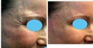 50 Year Old Woman Treated With Botox By Dr Nelson Castillo, MD, Atlanta Plastic Surgeon