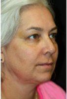 50 Year Old Woman Treated With Botox For Forehead By Doctor Kris M. Reddy, MD, FACS, West Palm Beach Plastic Surgeon