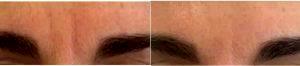 50 Year Old Woman Treated With Botox With Doctor Tracy Evans, MD, FAAD, San Francisco Dermatologic Surgeon
