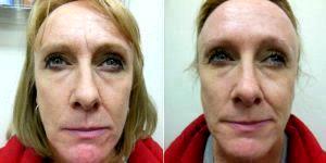 50 Year Old Woman Treated With Preventative Botox Of Glabellar Lines