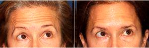 51 Year Old Woman Treated With Botox By Doctor Douglas Wu, MD, San Diego Dermatologist