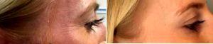 52 Year Old Woman Treated With Botox Crows Feet Before And After