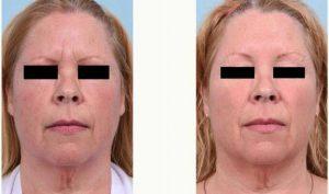 53 Year Old Woman Treated Facial Wrinkles With Botox While Maintaining Full Movement By Doctor Victor Chung, MD, San Diego Facial Plastic Surgeon