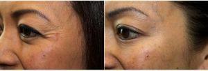 54 Year Old Woman Treated With Botox Around Eyes By Dr. Laura Phan, MD, Los Gatos Physician