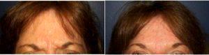 54 Year Old Woman Treated With Preventative Botox Glabella With Doctor Jeremy A. Benedetti, MD, Saint Petersburg Plastic Surgeon