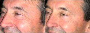 57 Year Old With Deep Crows Feet Treated With Botox By Dr Lisa Lynn Sowder, MD, Seattle Plastic Surgeon