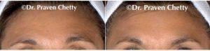 57 Year Old Woman With Symmetric Brows After Botox Before With Dr Praven Chetty, MD, Kelowna Physician