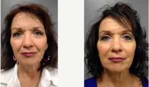 57yr Old Female Treated With Juvederm XC Plus In Nasolabial Folds (Smile Lines) With Doctor Spencer Berry, MD, Fargo Family Physician