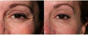 59 Year Old Woman Treated With Botox To Crows Feet By Dr. Marc Cohen, MD, Philadelphia Oculoplastic Surgeon