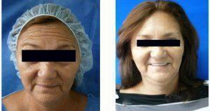 60 Year Old Woman Treated With Preventative Botox By Dr. Luis A. Mejia, MD, Dominican Republic Plastic Surgeon